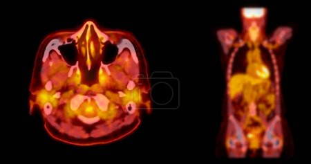 Une image de TEP-TDM est une visualisation diagnostique combinant la tomographie par émission de positrons (TEP) et la tomodensitométrie (TDM) pour aider à trouver la récurrence du cancer.