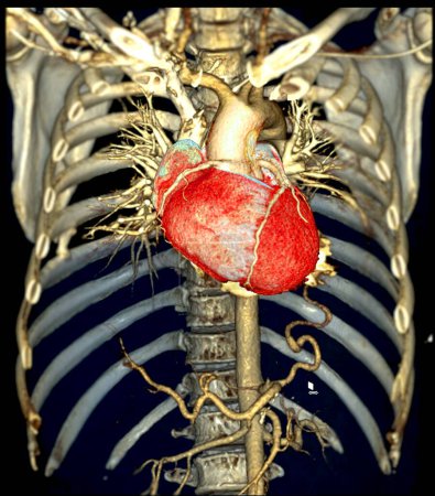 Le rendu 3D de l'aorte thoracique CTA offre une visualisation détaillée, fournissant des informations claires sur l'anatomie de l'aorte, la pathologie et les structures environnantes pour un diagnostic précis et une planification du traitement.