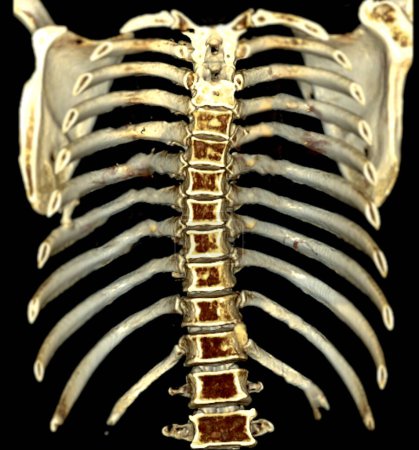 CT scan rib 3D rendering provides precise imaging of rib structures.