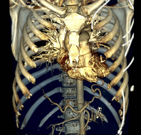 Photo for CTA thoracic aorta 3D rendering offers detailed visualization, providing clear insights into aortic anatomy, pathology, and surrounding structures for accurate diagnosis and treatment planning. - Royalty Free Image