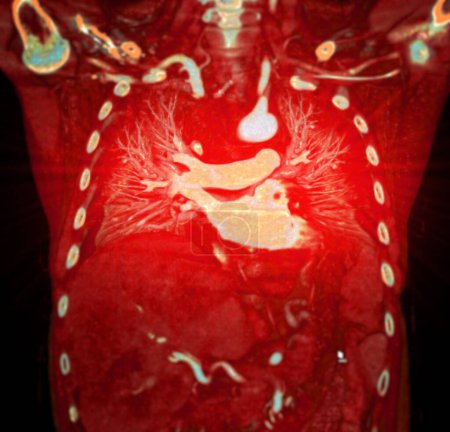 Photo for CTA thoracic aorta 3D rendering offers detailed visualization, providing clear insights into aortic anatomy, pathology, and surrounding structures for accurate diagnosis and treatment planning. - Royalty Free Image