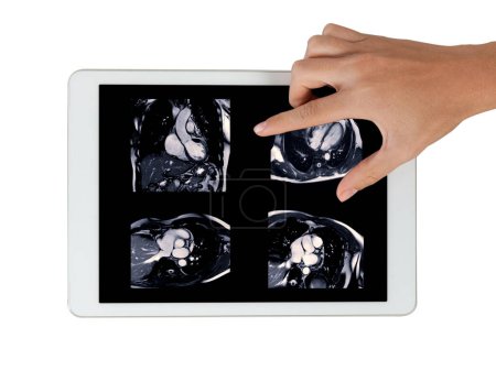 Las imágenes de resonancia magnética cardiaca en la tableta son fundamentales para evaluar la salud cardiaca, identificando anomalías cardiacas aisladas en el fondo blanco..