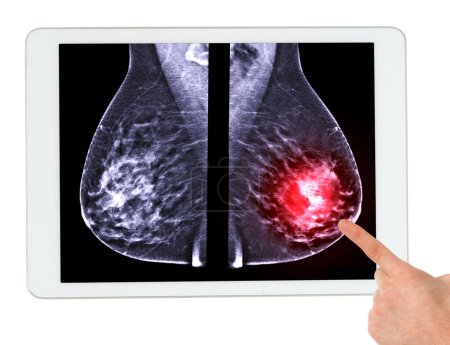 X-ray Digital Mammogram both breast  MLO view on tablet , mammography or breast scan for Breast cancer showing lesion of the Left breast.Clipping path.