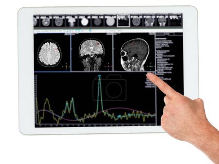 MR spectroscopy aids in stroke diseases on tablet, providing insightful chemical analysis to understand metabolic changes in affected brain tissues.Clipping path.