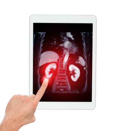 MRI of the upper abdomen coronal view on tablet is a non-invasive imaging technique providing detailed visuals of organs like the liver, pancreas, and kidneys.