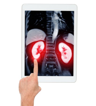 MRI of the upper abdomen coronal view on tablet is a non-invasive imaging technique providing detailed visuals of organs like the liver, pancreas, and kidneys.