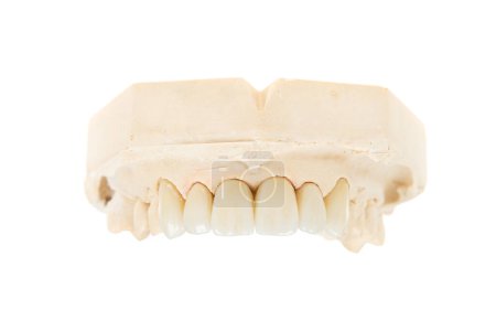 Photo for Dental health care. Ceramic zirconium in final version. Close up dental zircon ceramic crown, isolated - Royalty Free Image