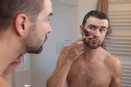 Téléchargez les photos : Portrait de jeune homme avec une grosse tache de naissance sur le visage devant le miroir dans la salle de bain - en image libre de droit