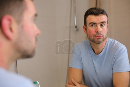 Photo for Portrait of handsome young man with red sunburnt skin on face in front of mirror in bathroom - Royalty Free Image