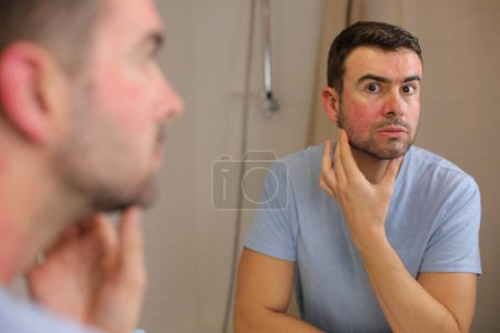 Photo for Portrait of handsome young man with red sunburnt skin on face in front of mirror in bathroom - Royalty Free Image