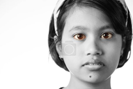 Nahaufnahme monochromer Ansicht des gelben rötlichen Auges eines indischen Mädchens, Gesundheitskonzept