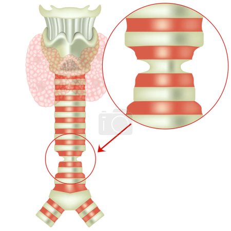 Ilustración de Estenosis traqueal. Tiroides. Anatomía del sistema respiratorio y endocrino. Ilustración vectorial. - Imagen libre de derechos