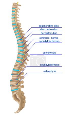 Beschädigte Wirbelsäule. Infografiken zu verschiedenen Rückenerkrankungen. Vektorillustration