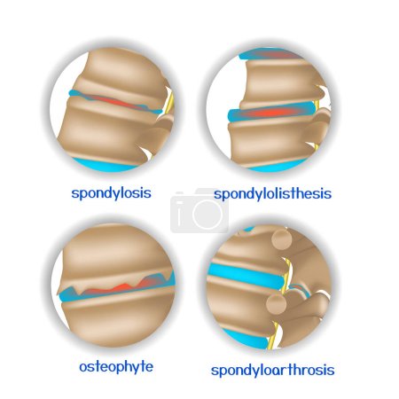 Spine diseases. Various pathologies of intervertebral discs and bones. 4 round icons. Vector illustration.