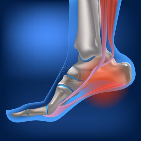 Illustration for Plantar fasciitis, plantar fasciosis. inflammatory and degenerative changes in plantar fascia. Pain during walking. Vector 3D rendering of the human foot in flexed position - Royalty Free Image