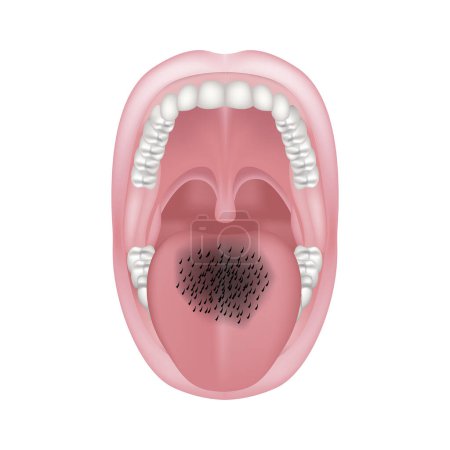 Illustration for Glossite fleecy. Overgrowth of the papillae of the tongue with permanent trauma and candidiasis. Medical poster. Vector illustration. - Royalty Free Image