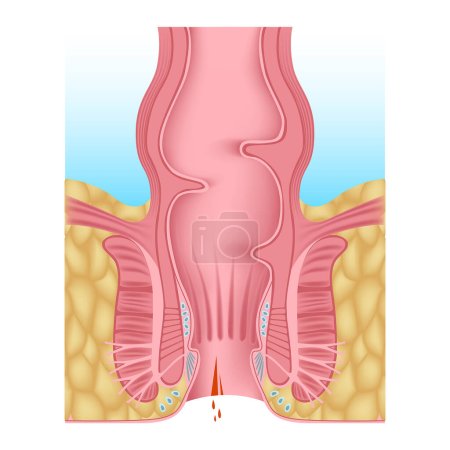 anal fissure. Hemorrhoids of the anal opening. Digestive system anatomy. Medical chart. Hemorrhoidal plexus. Vector illustration