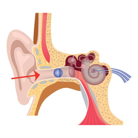 Illustration for Foreign body in the inner ear. The structure of the human auditory system. Medical poster. Vector illustration - Royalty Free Image