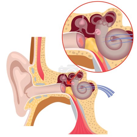 Ilustración de Anatomía del oído interno. Daño a la membrana timpánica. Acumulación de pus. ilustración médica. - Imagen libre de derechos