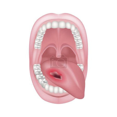 cáncer de lengua, cavidad oral. La herida está en la boca. Oncología. Anatomía mandibular. Ilustración vectorial