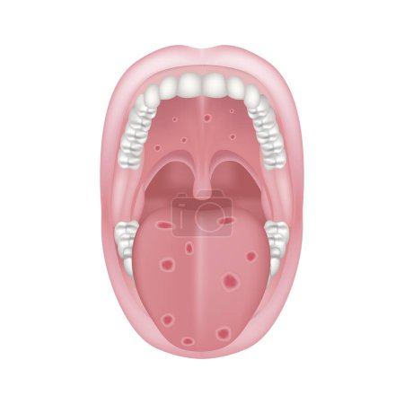 Illustration for Oral syphilis. Venereal disease. Ulcers on the tongue and palate. Vector illustration - Royalty Free Image