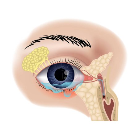 Illustration for Teary inflamed eye. Blockage of the lacrimal sac or ducts. - Royalty Free Image