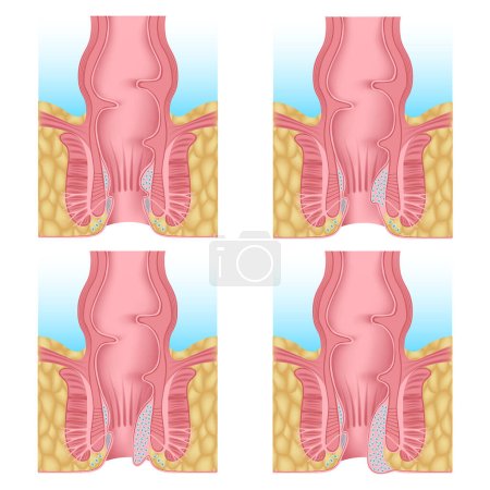 stages of development of hemorrhoids. Gradual proliferation of hemorrhoidal plexuses. Anatomy of the human anus. Vector illustration.