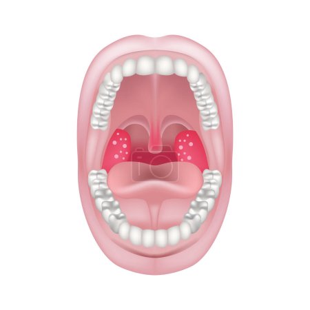 Illustration for Acute tonsillitis and pharyngitis. Bloating and redness of the mendals. Throat ailments. Vector illustration. - Royalty Free Image