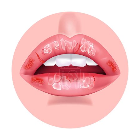 Illustration for Chronic cheilitis. Dry chapped lips. Ripped skin. Disease of the mouth. Flaking skin flakes. Vector illustration - Royalty Free Image
