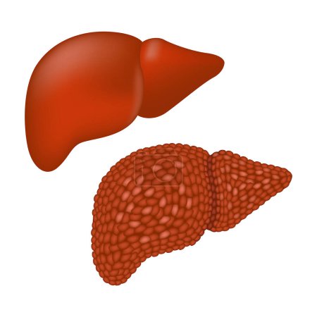 Cirrosis del hígado humano. Destrucción de órganos por alcoholismo. Ilustración vectorial