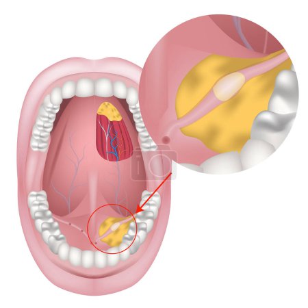 Ilustración de Piedra en los conductos de las glándulas salivales. Diagrama que muestra neoplasia. El suelo de la boca. Anatomía del sistema digestivo y la lengua. Ilustración vectorial - Imagen libre de derechos