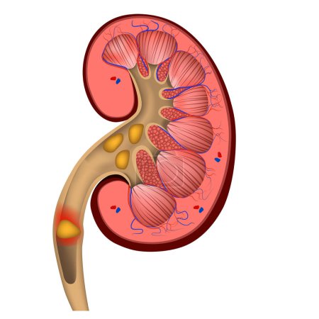 Renal colic. the formation of stones in the organs. human kidney. Vector illustration