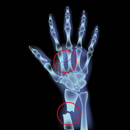 Illustration for Fracture of the metacarpal and radius bones. X-ray of a man's hand. Vector illustration - Royalty Free Image