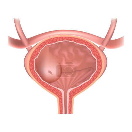 Ureterocele. la estructura del sistema genitourinario humano. compartimento vesicular. Hernia en la vejiga urinaria. Ilustración vectorial.