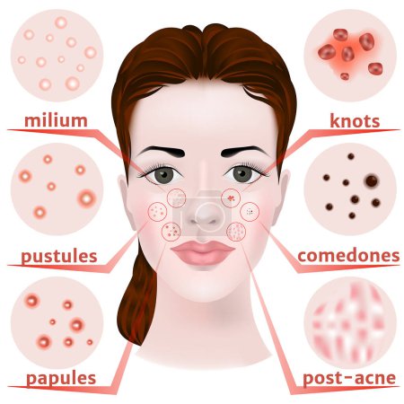 Akne im Gesicht. Arten von Hauterkrankungen. Schwarze Punkte. Die Drüsen funktionieren nicht richtig. Akne und Akne Post Set. Vektorillustration.