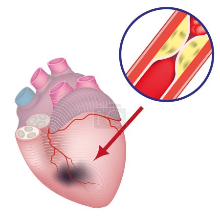 Illustration for Ischemia of the heart. Vascular atherosclerosis. damage to the coronary arteries. Fatty plaques on the walls. Blood clots. High risk of death. Vector illustration. - Royalty Free Image