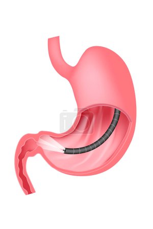 Ilustración de Gastroscopia. Examen endoscópico del estómago. La membrana mucosa del tracto digestivo. esofagogastroduodenoscopia, fibrogastroduodenoscopia. Ilustración médica del vector - Imagen libre de derechos