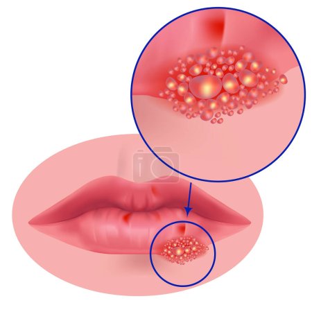 Herpes auf den Lippen aus nächster Nähe. Vektor medizinische Illustration