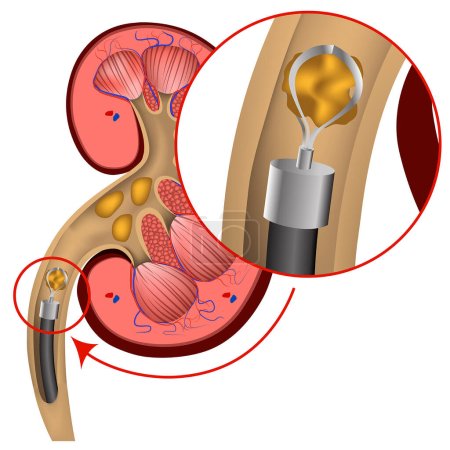 Illustration for Endoscopic removal of kidney stones. Vector medical illustration - Royalty Free Image