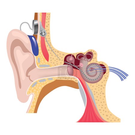 Ilustración de Sistema de implantación coclear. Audífono con cirugía de oído interno. Arreglo electrónico. Ilustración vectorial - Imagen libre de derechos