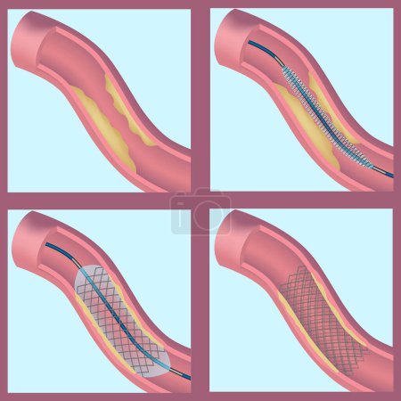 Illustration for Stening of blood vessels and veins. Restoration of blood flow. The formation of fatty plaques. Coronary heart disease. Atherosclerosis of the arteries. Insufficiency of blood circulation. Vector - Royalty Free Image