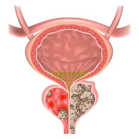 Adenoma de próstata. Cáncer de órganos con muchos cálculos. Obstrucción uretral. Vejiga. Ilustración vectorial.