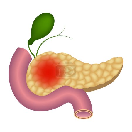 Illustration for Inflammation of the human pancreas. Duodenum. The gallbladder. Vector illustration. - Royalty Free Image