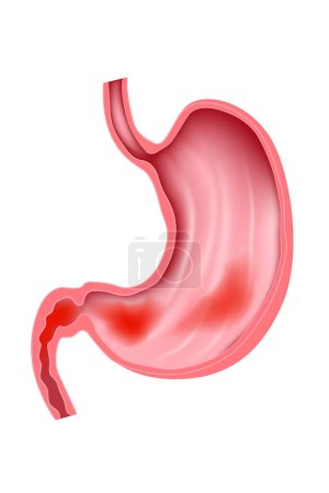 Ilustración de Gastroduodenitis. Inflamación de las membranas mucosas del estómago y el duodeno. - Imagen libre de derechos