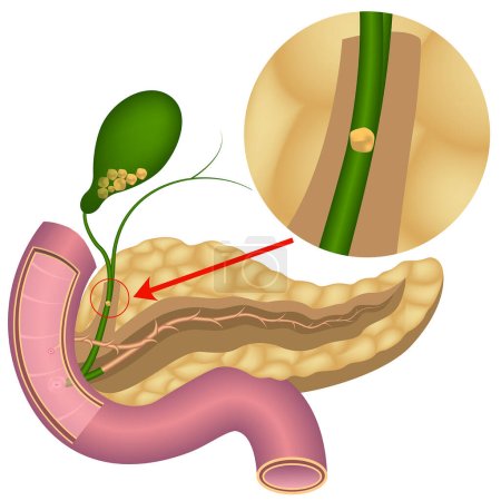 Illustration for Cholelithiasis. Formations in the gallbladder. Blockage of the bile duct. Pancreas. - Royalty Free Image