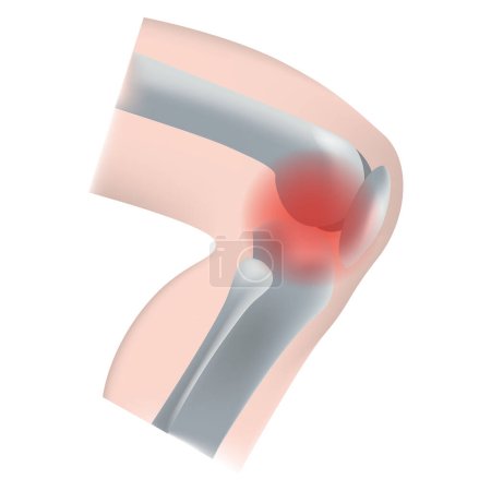 Inflammation des articulations du genou. L'apparence des os du côté. Fibule, tibia, rayon. Illustration vectorielle.