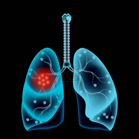 Radiografía de los pulmones. Inflamación o inflamación. El cáncer está indicado por una formación roja. Ilustración vectorial.