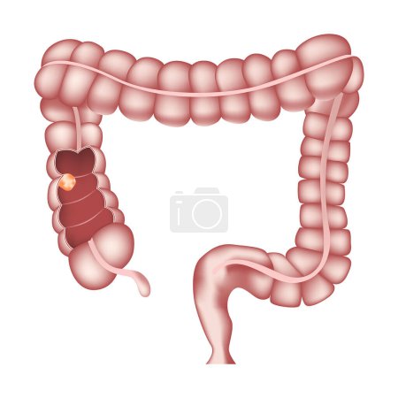 Illustration for Bowel cancer. Internal organs anatomy. Tumor. Vector illustration. - Royalty Free Image