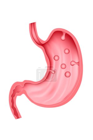 Illustration for Polyp of the stomach. Pathology of the digestive system. Vector illustration. - Royalty Free Image