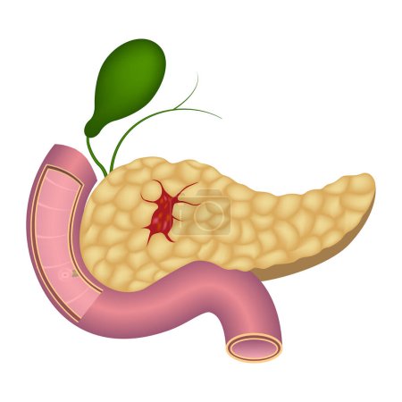 Illustration for Pancreas cancer. Large erosion on the organ. deadly disease. Vector illustration. - Royalty Free Image